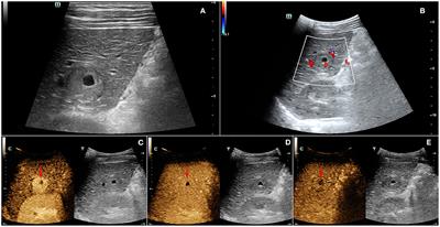 Contrast-Enhanced Ultrasound Findings of Hepatocellular Carcinoma With Neuroendocrine Carcinoma: A Case Report